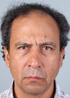 Before Hair Transplant&nbsp;Front